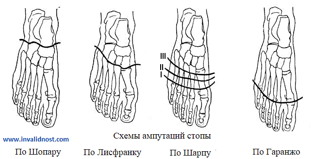 Ампутация по шопару схема