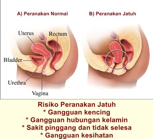 Apabila masalah ini berlaku ia boleh membuatkan rahim jatuh dan keluar menerusi faraj. Cara Untuk Mengenalpasti Rahim Jatuh Atau Tidak Irdina Legacy Hq Penangannya Yang Luar Biasa