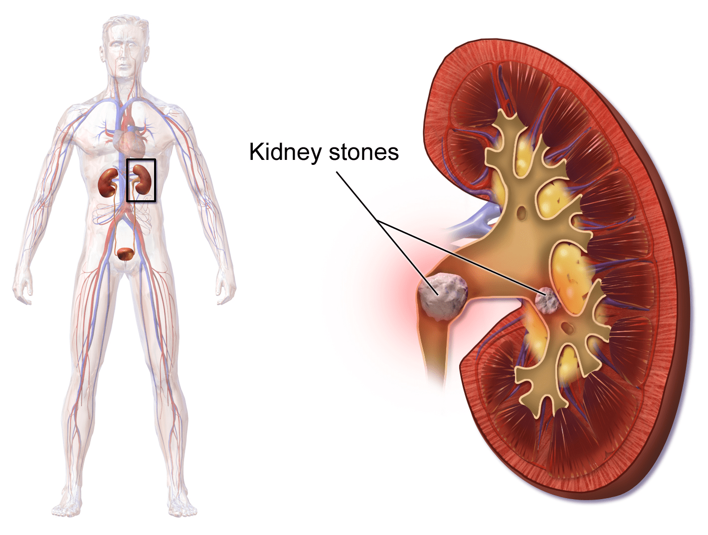 home-remedies-for-kidney-stone-treatment-at-home