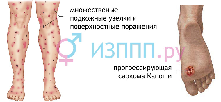 Ранние признаки вич которые должен знать каждый. Первые симптомы вич инфекции