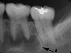 Osseous Cemento Osseous Dysplasia Of The Jaws Clinical And Radiographic Analysis Jcda