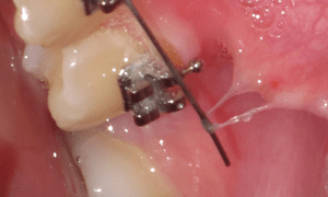 Dent Orthodontie Douleur  : L�orthodontie Et La Croissance De La Mâchoire.