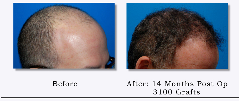 Before & After Hair Transplant Gallery Columbus, OH Hair Loss