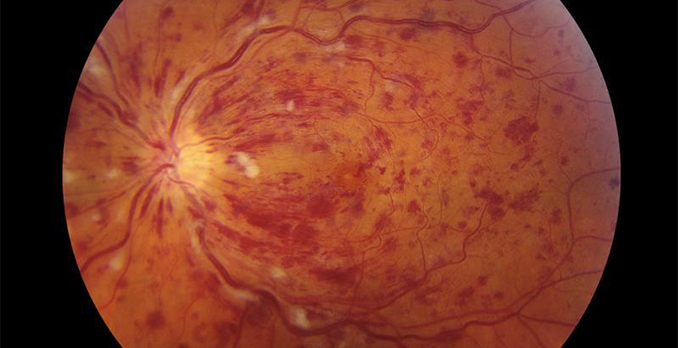 Read on to learn more about how to mount window. Man with Decreased Vision in One Eye
