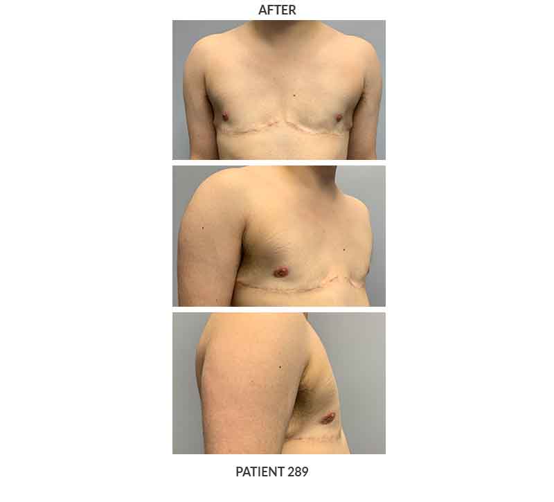 Ftm Top Surgery Post Op Photos Keelee Macphee M D