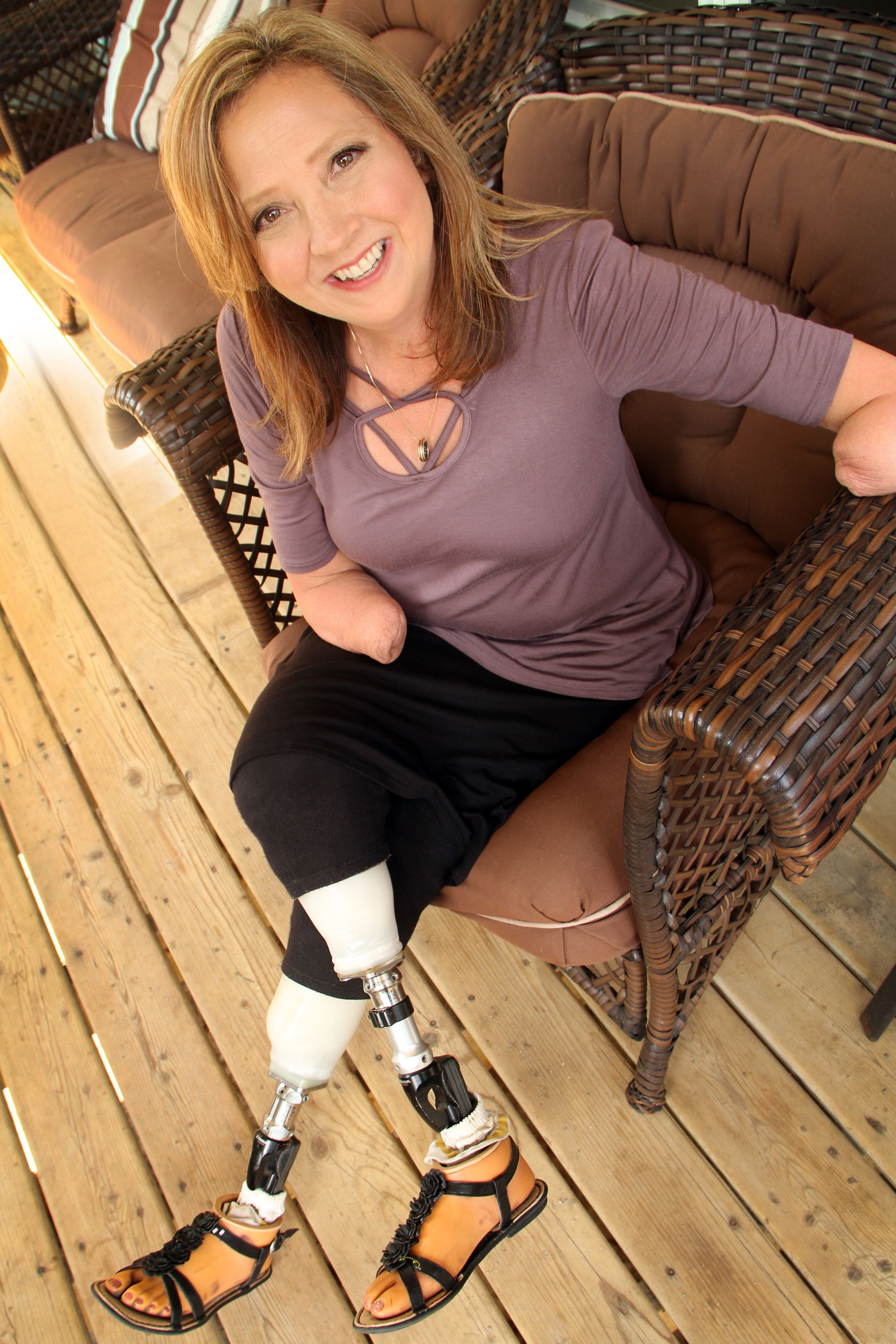 Shine On The Remarkable True Story of a Quadruple Amputee