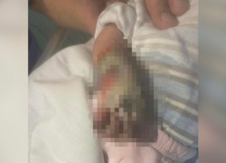 «Туура эмес укол сайышкан». Токтогулда колу кесилген эки айлык ымыркайдын ишин милиция текшере баштады