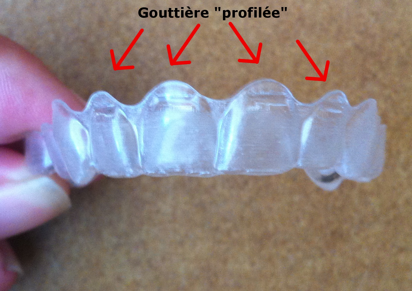 Gouttiere Dent Du Haut  : Système De Gouttières Transparentes Sur Mesure, Smilers® Permet De Corriger Les Malpositions Dentaires Par L�application De Forces Particulièrement Faibles.