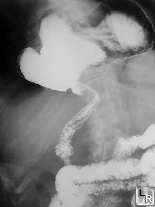 Learn what blind people see and about how being born blind or losing sight affects the experience. LearningRadiology - Gastric Volvulus, Organoaxial