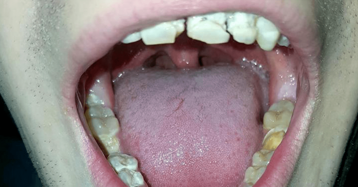 Le Plus Rapide Dent Pourrie Asticot