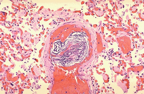 Saddle embolus of pulmonary artery without acute cor pulmonale i26.99 other pulmonary embolism without acute cor pulmonale i27.0 primary pulmonary hypertension i27.1 kyphoscoliotic heart disease i27.20 pulmonary hypertension, unspecified i27.21. Pulmonary Pathology