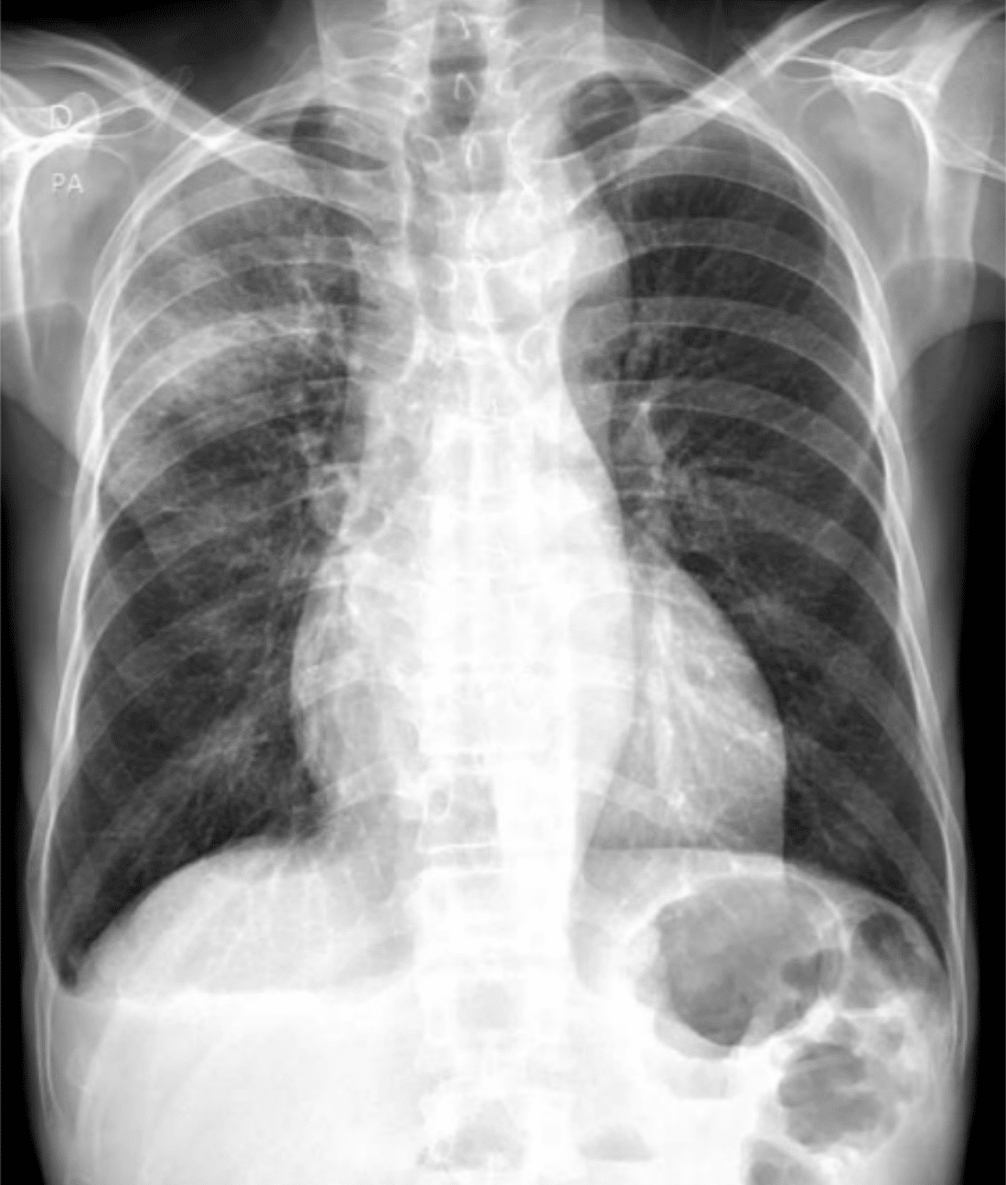 Cxr Case 154 Litfl Chest X Ray Self Assessment Quiz