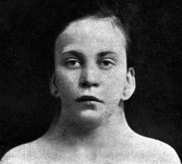 Turner syndrome • LITFL • Medical Eponym Library