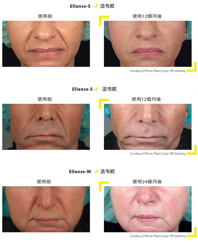 青春痘治療英文痤瘡 Guvxn