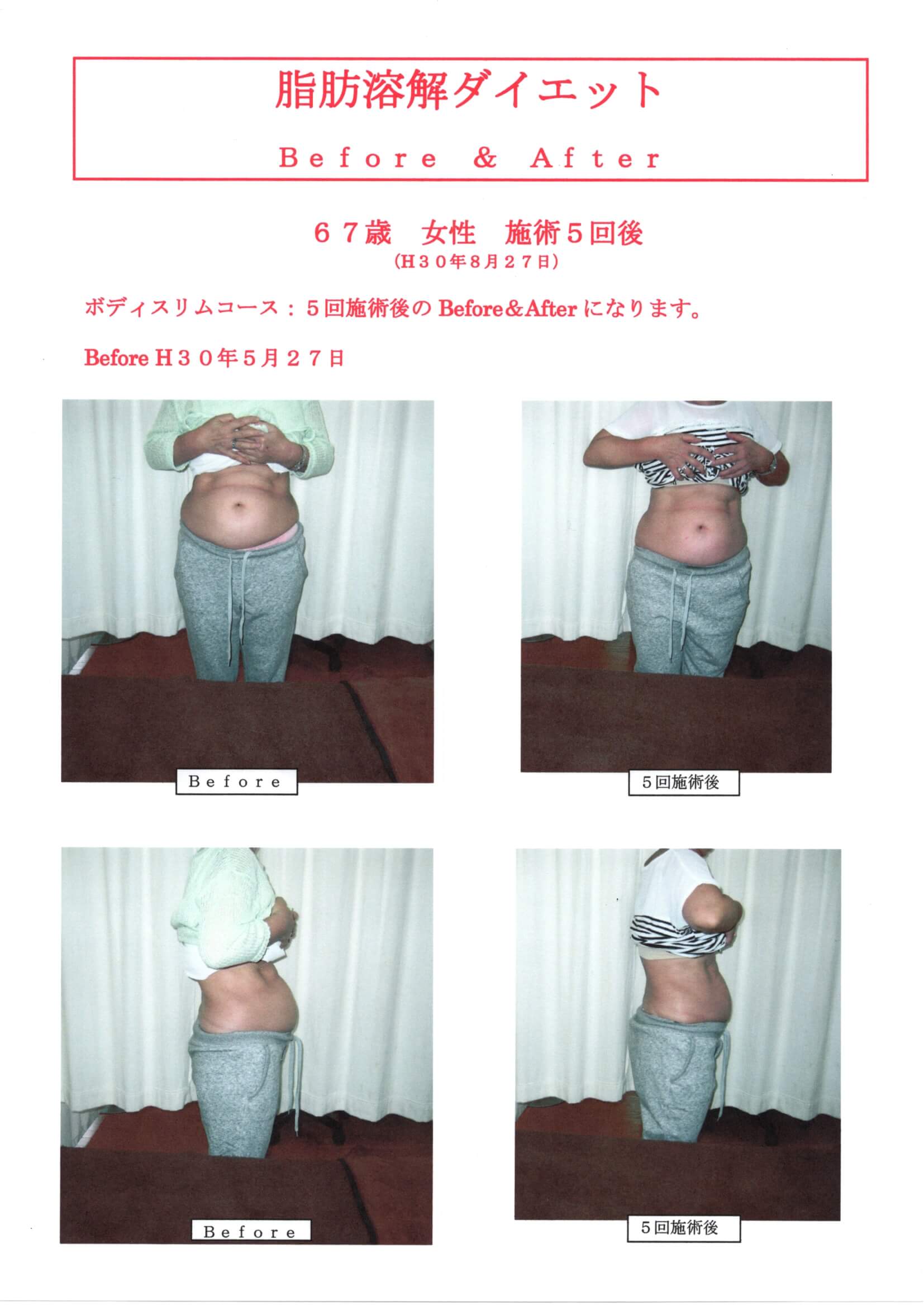 脂肪溶解ダイエット　５回施術後""