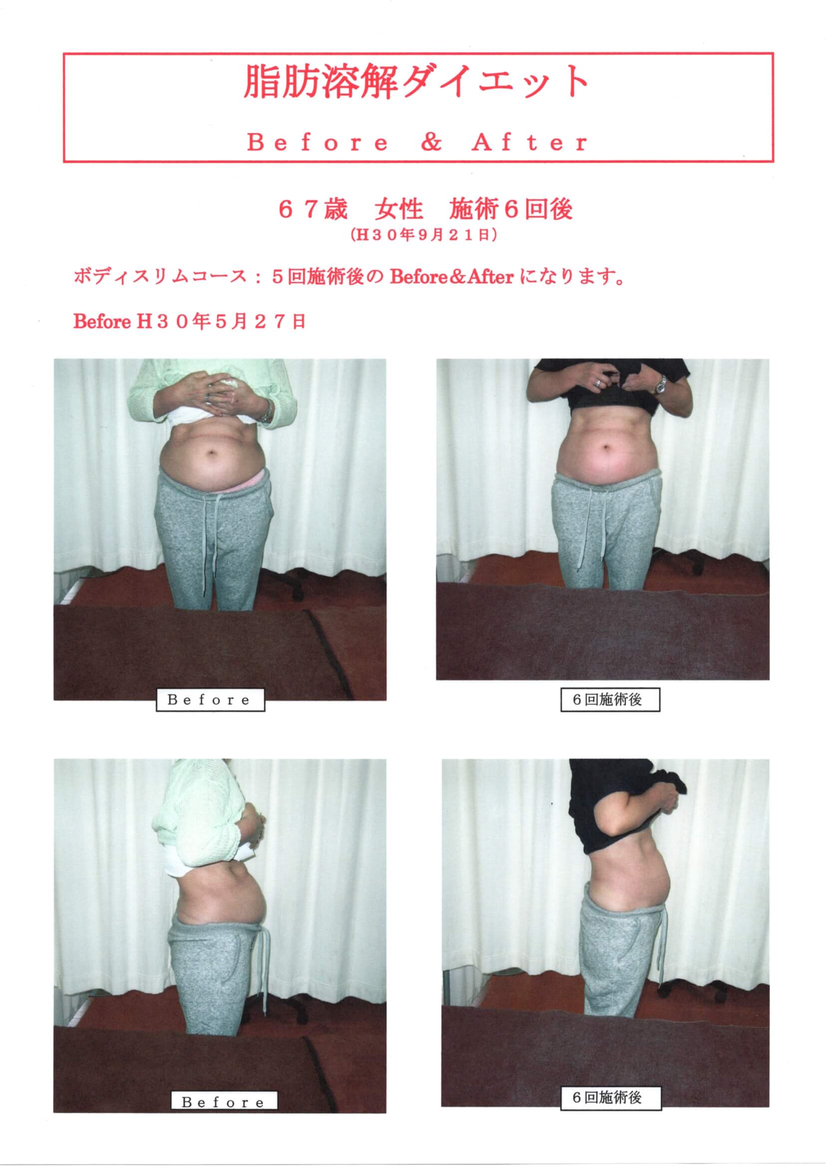 "脂肪溶解ダイエット　６回施術後