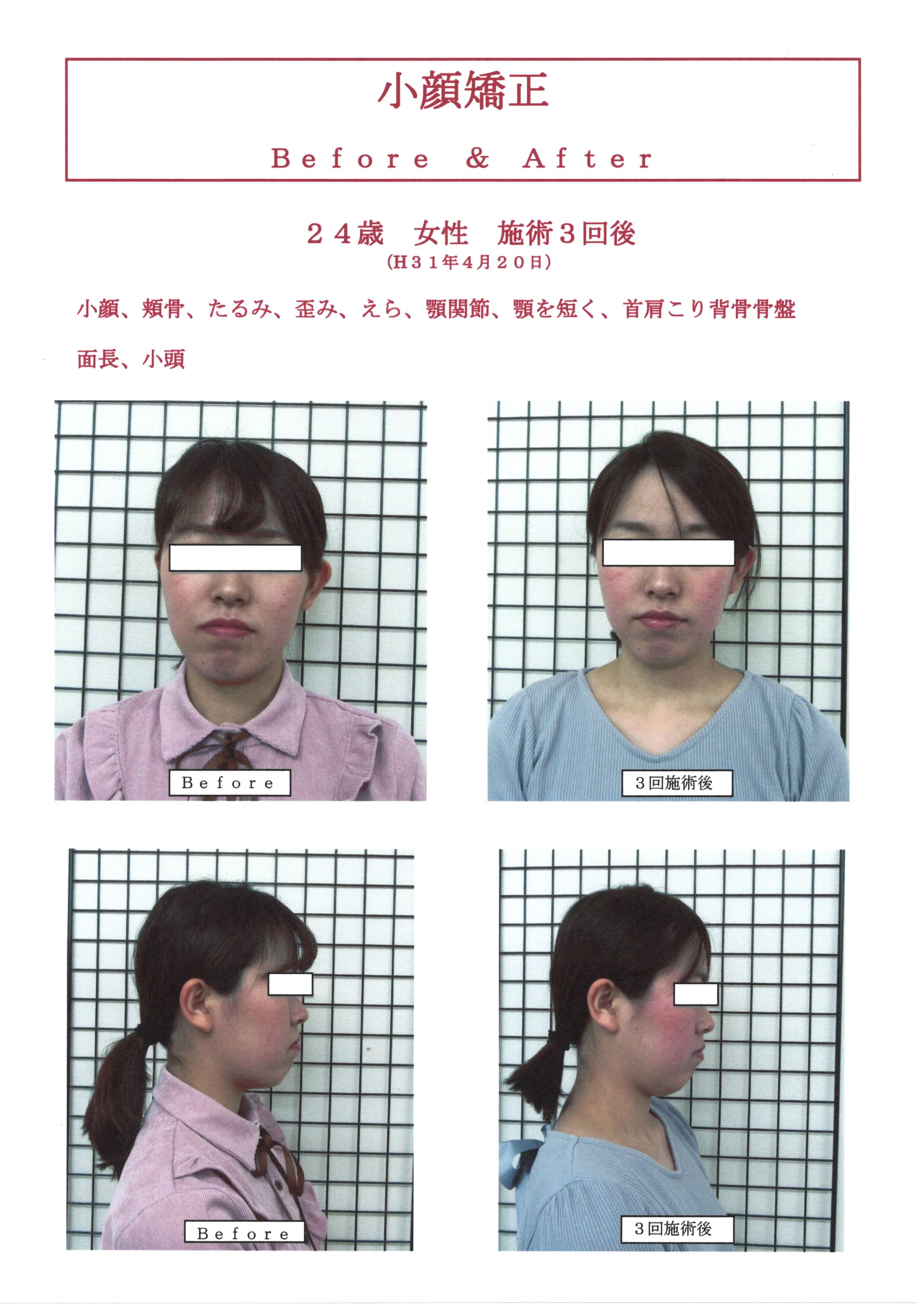 小顔矯正
