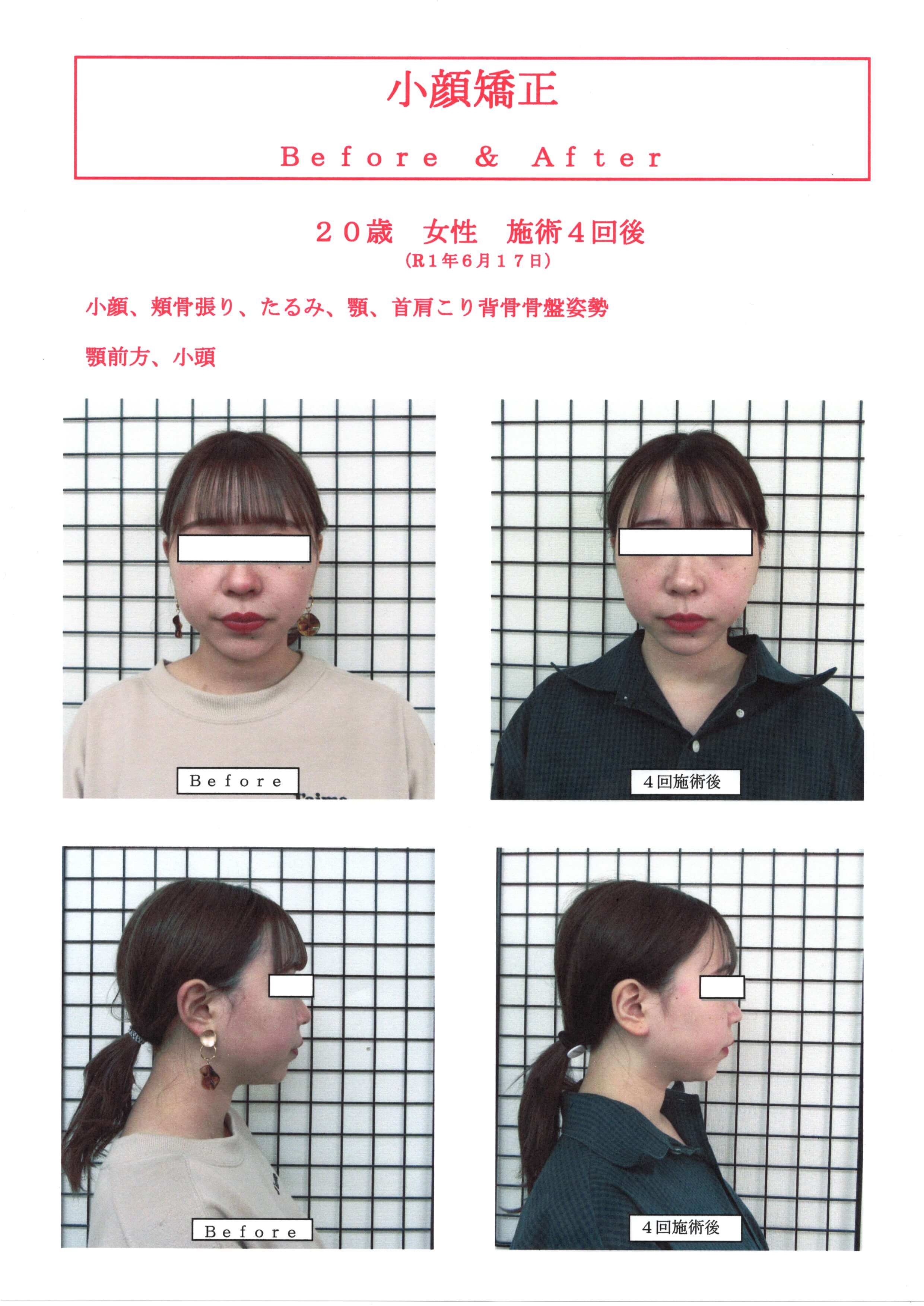 ダイエット　小顔矯正　割引特典