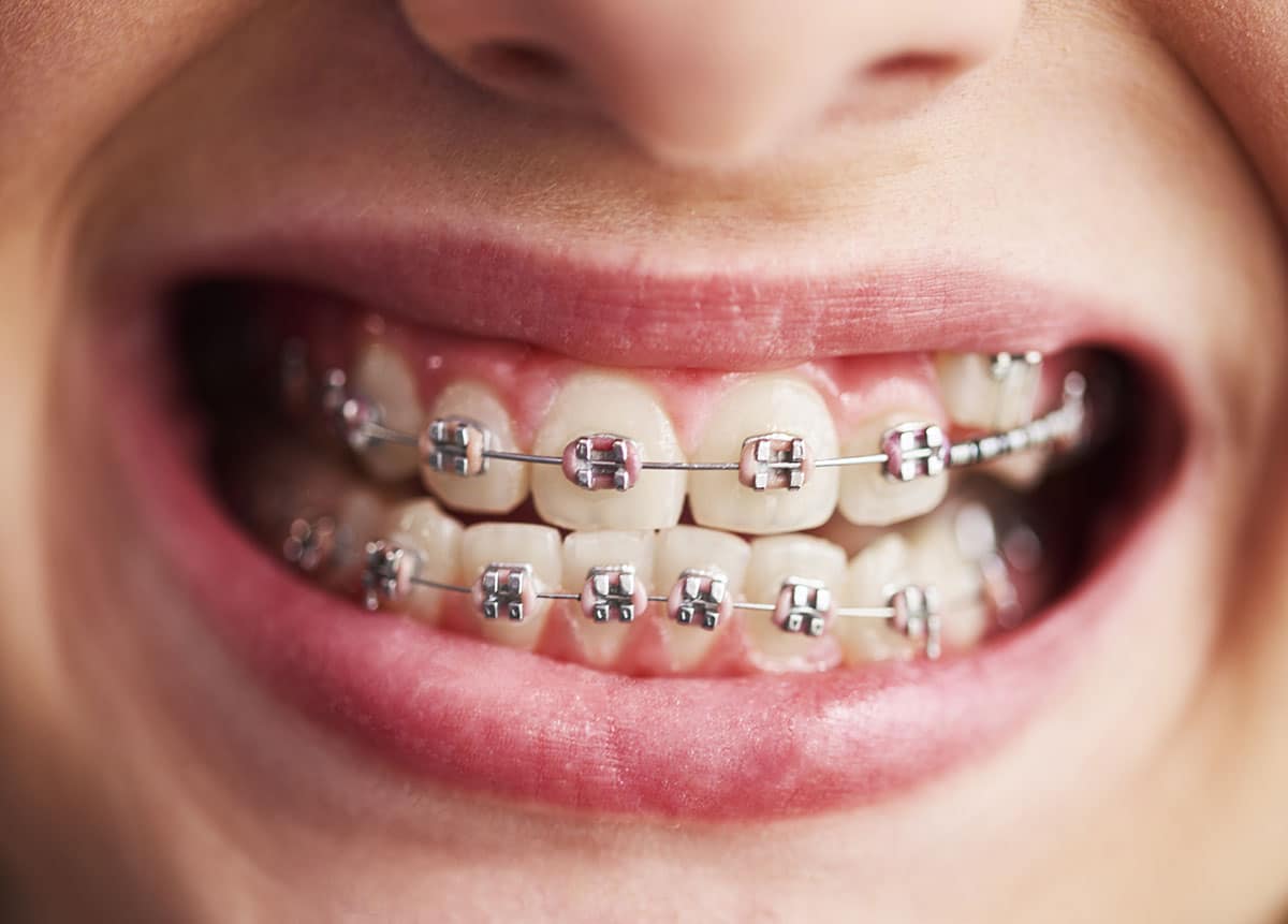 What colour braces do we offer? Do I Need Braces Marcus Black Dds Dentistry Services In Rogers Ar