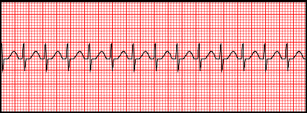 For longer periods of time, another tape of the rhythm recording device may be used. Section 8 : Supraventricular Tachycardias