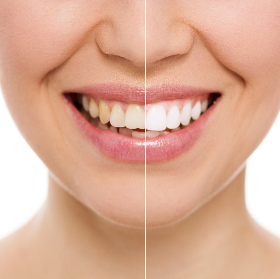 Paper price lists that you take home with you will be a simplified. How Much is Teeth Whitening? How Much Does it Cost? (UK)