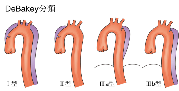 上行大動脈瘤の今後の見通しはどうなりますか?