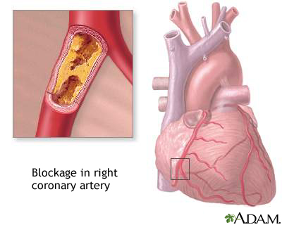 pic Familial Hypercholesterolemia Symptoms medlineplus