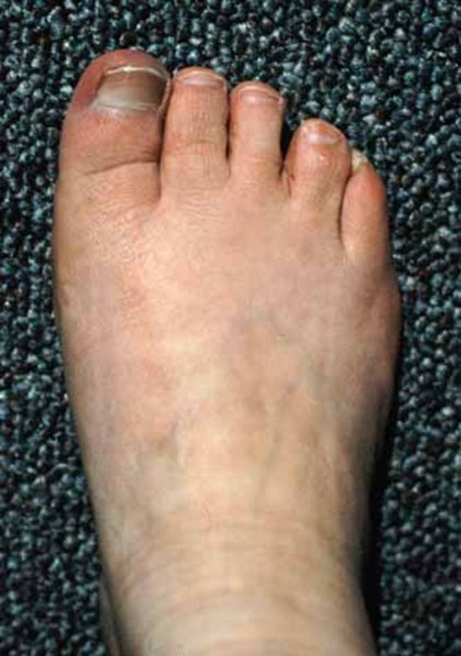 Resolution is seen in about 20% of the cases surgical treatment (flexor tenotomy) is recommended if the deformity is symptomatic … Carpenter Syndrome Medlineplus Genetics