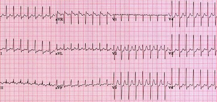 12 lead ecg showing regular narrow complex tachycardia. Supraventricular tachycardia - AV reentry