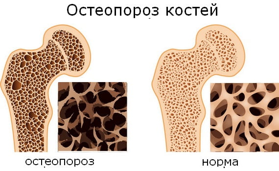 Яка хвороба – остеопороз.  Остеопороз - що це за хвороба, причини та симптоми