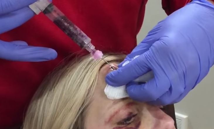 Woman gets 'Goose Egg' removed from forehead Metro News