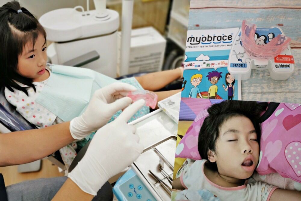 兒童牙齒矯正》MRC功能性齒顎矯正。8Y米姐開啟牙齒矯正之路~
