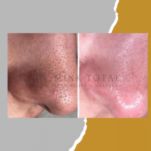 Before and after of a Skin Care Treatment to extract and clean the pores on a man's face.