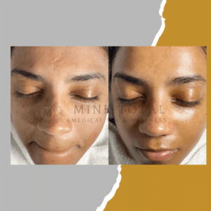 Before and after of a Skin Care Treatment on a woman's face.