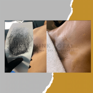 Before and after of Hair Removal Services on a woman.