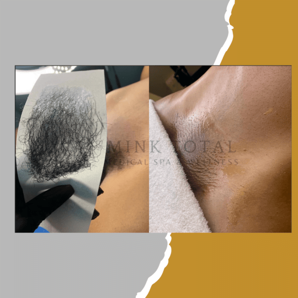 Before and after of Hair Removal Services on a woman.