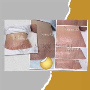 Before and after of a Body Treatment on a woman's stretch marks on her belly.