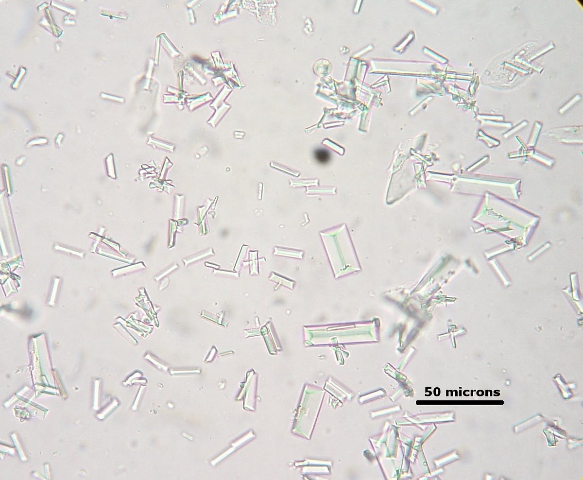 pic Cristales Segun El Ph De La Orina medium