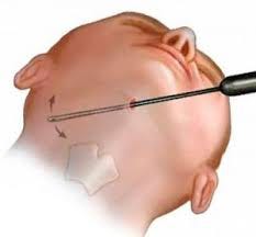 La Génioplastie : Une liposuccion pour éliminer le double menton | by elle  esthetique1 | Medium