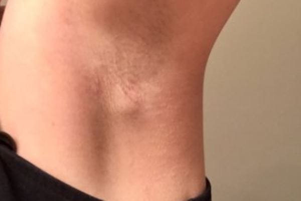 Cara Menghilangkan Benjolan Di Ketiak Kiri Secara Alami