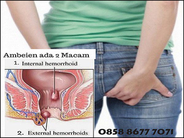 Minuman Makanan Sehat Untuk Penderita Wasir | by Sembuhkan Ambeien Dengan  Cara | Medium