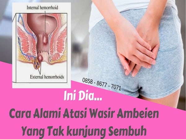 Cara Alami Mengobati Wasir Dengan Cepat | by Cara Obati Wasir Tanpa Operasi  | Medium