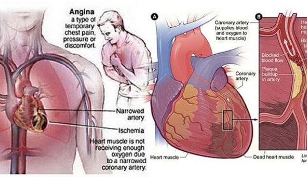 Sakit Tulang Rusuk Sebelah Kiri - Nuring