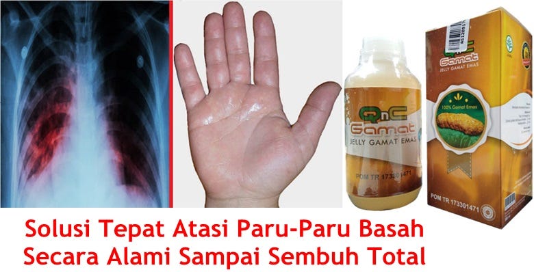 Penyebab Paru Paru Basah Pada Dewasa - Berbagai Sebab