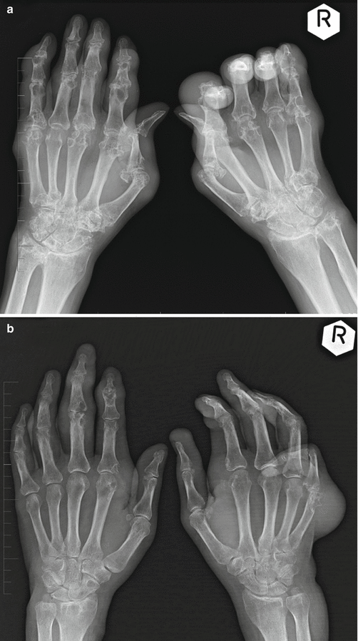 Clinical Syndromology of Gouty Arthritis Musculoskeletal Key
