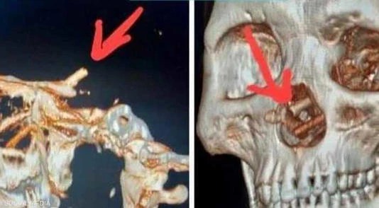 في حالة غريبة.. رجل يكتشف &ldquo;مفاجأة&rdquo; داخل جمجمته