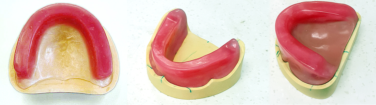 Denture Occlusal Rim  - Desirable Occlusal Contact Relationships For Removable Partial Dentures.