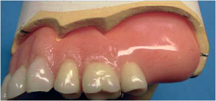 Denture Base Staining  . Next, Let�s Answer 12 Common Questions About Dentures