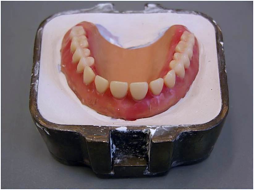 Denture Base Resins Wikipedia  . Soham Prajapati 1St Year Post Graduate, Dept.