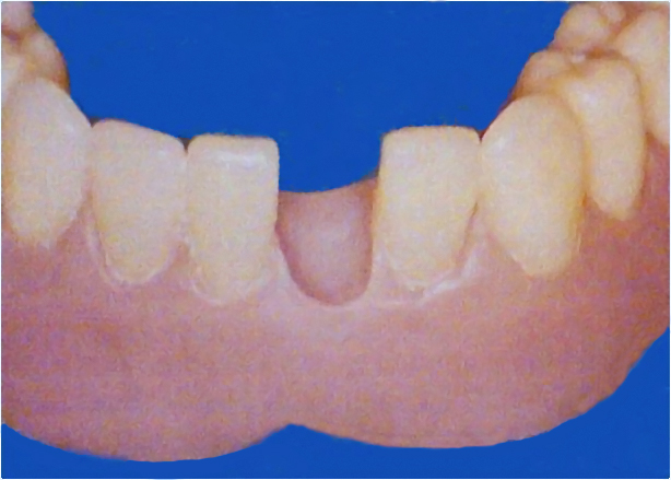 Repair Resin Denture Base Code  . Adhesion Of Permasoft To Each And Every Denture Base Resin Formulation Has Not Been Tested.